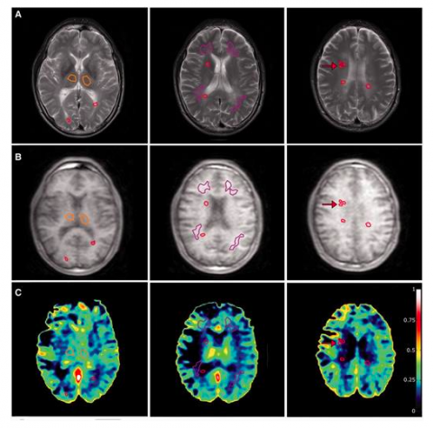 Avances de la resonancia magnética para la esclerosis múltiple