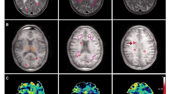 Avances de la resonancia magnética para la esclerosis múltiple